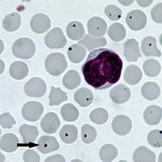 Human Granulocytic Anaplasmosis